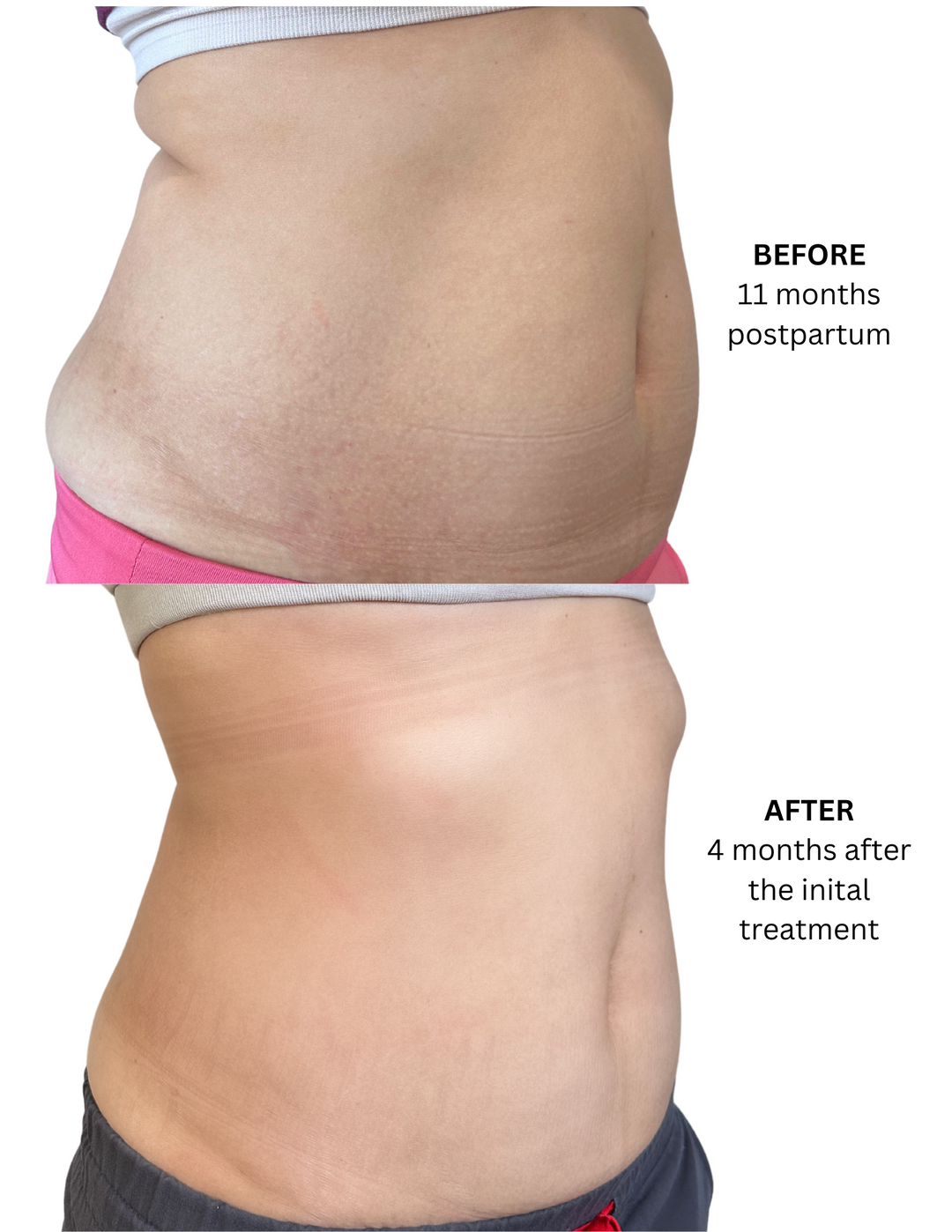 A New Mom's Guide to Balancing Life and Fitness with Evolve X by InMode