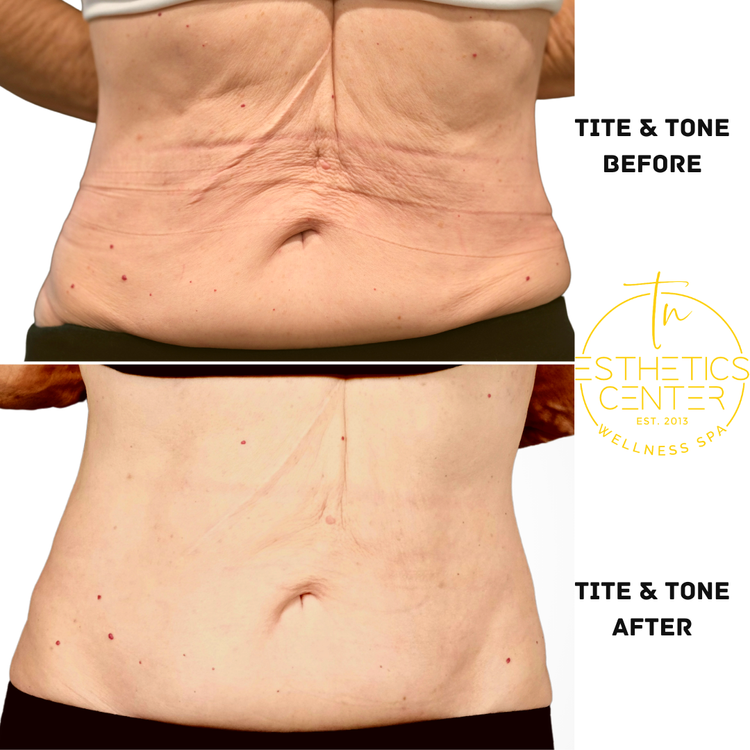 EvolveX TITE & TONE Dual Package: Skin Remodeling and Muscle Toning - 60 Minutes