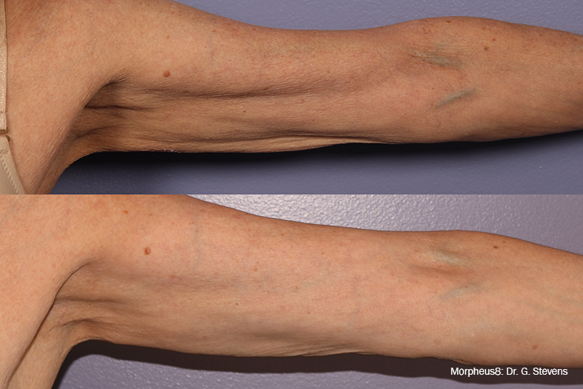 Before and after images showcasing tightened skin on an arm using Morpheus8 Burst technology.