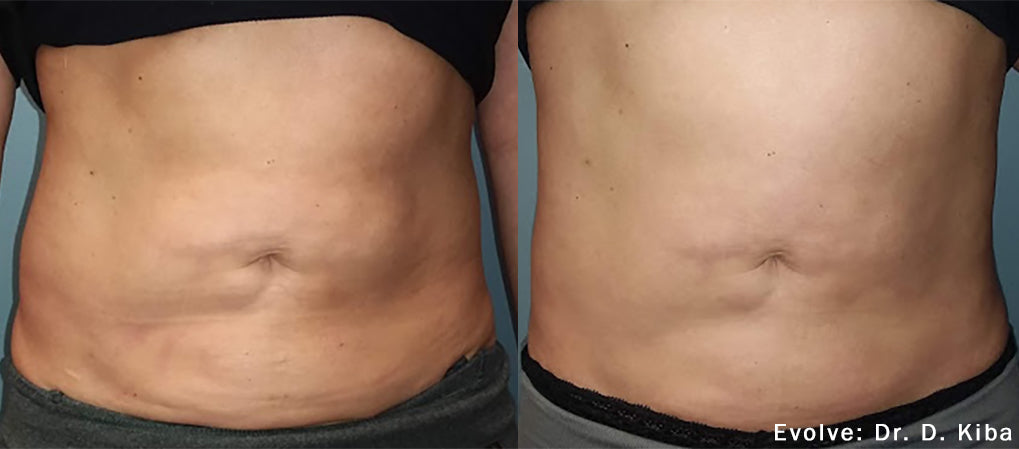 Morpheus8 Burst After GLP-1 Weight Loss in Cerritos, CA | TN Esthetics Center