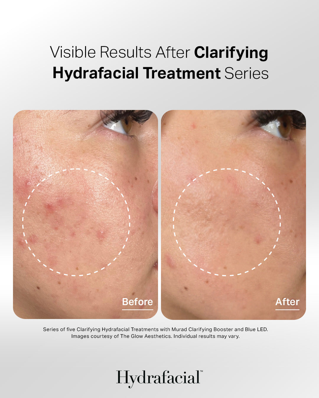 HydraFacial for Acne in Cerritos, CA | TN Esthetics Center