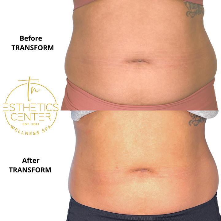 Evolve X - TRANSFORM Body Contouring