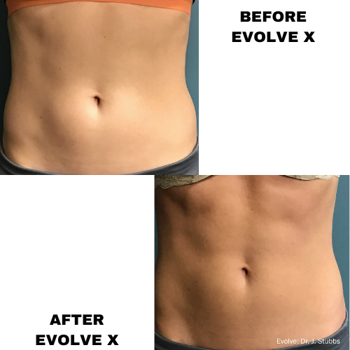 EvolveX TONE: Strengthening and Toning Muscle - 60 Minutes