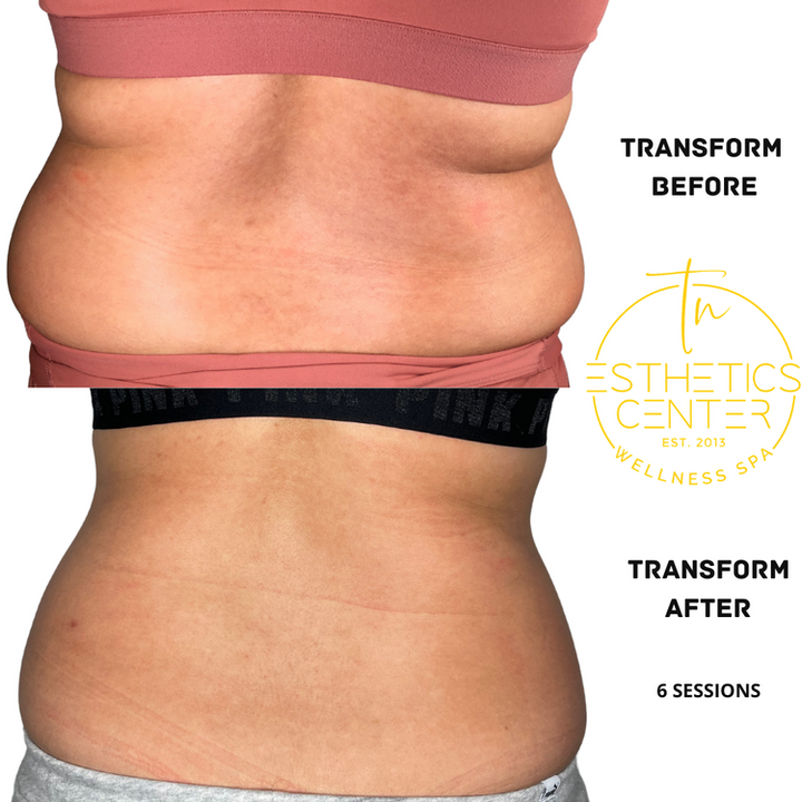 Evolve X - TRANSFORM Body Contouring
