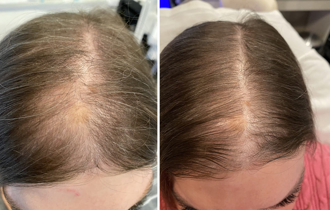 Hydrafacial Keravive - Scalp Therapy - 80 Minutes