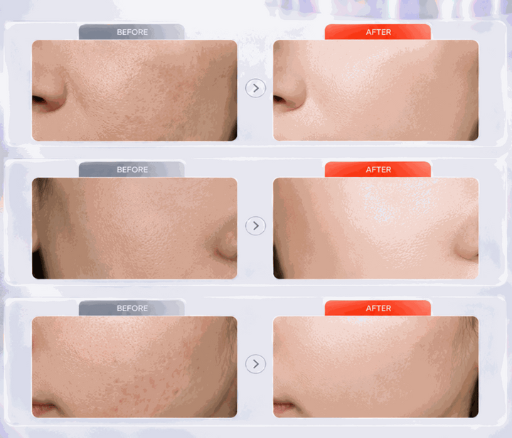 When combined with Tripple C and RF Microneedling, skin is looking more radiance and long lasting results., 