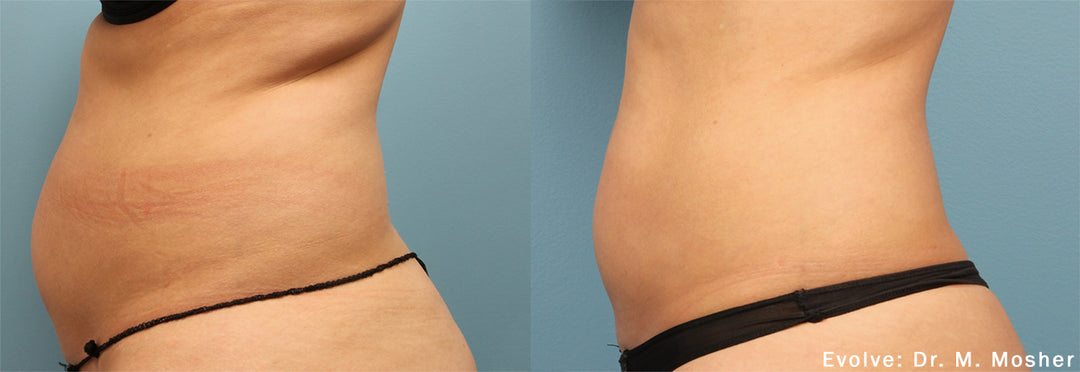 Evolve X - TRANSFORM Body Contouring