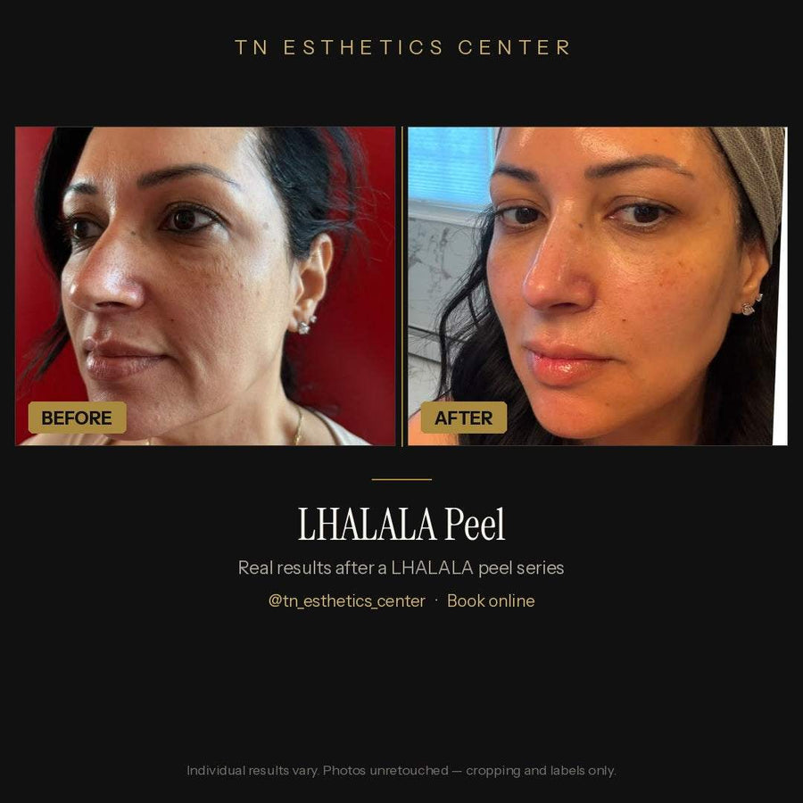 Lhalala Chemical Peel treatment showing smooth, radiant skin transformation without downtime
