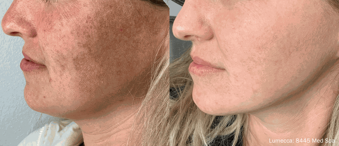 Lumecca IPL