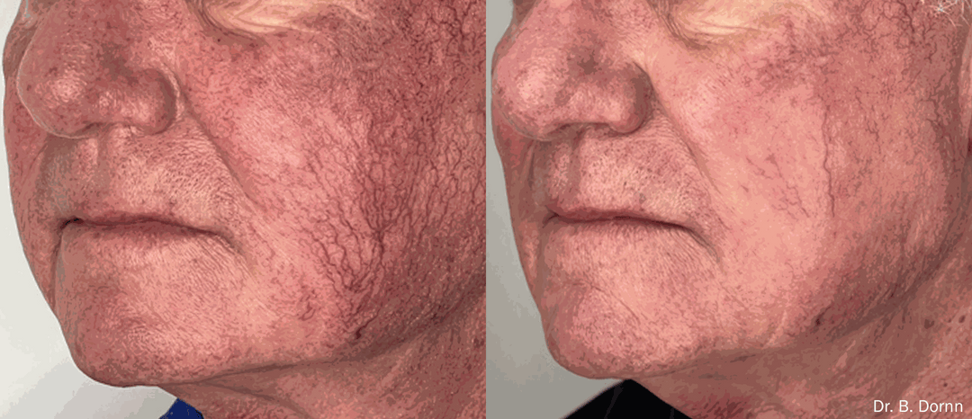 Lumecca IPL