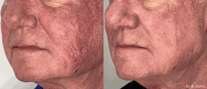 Lumecca IPL