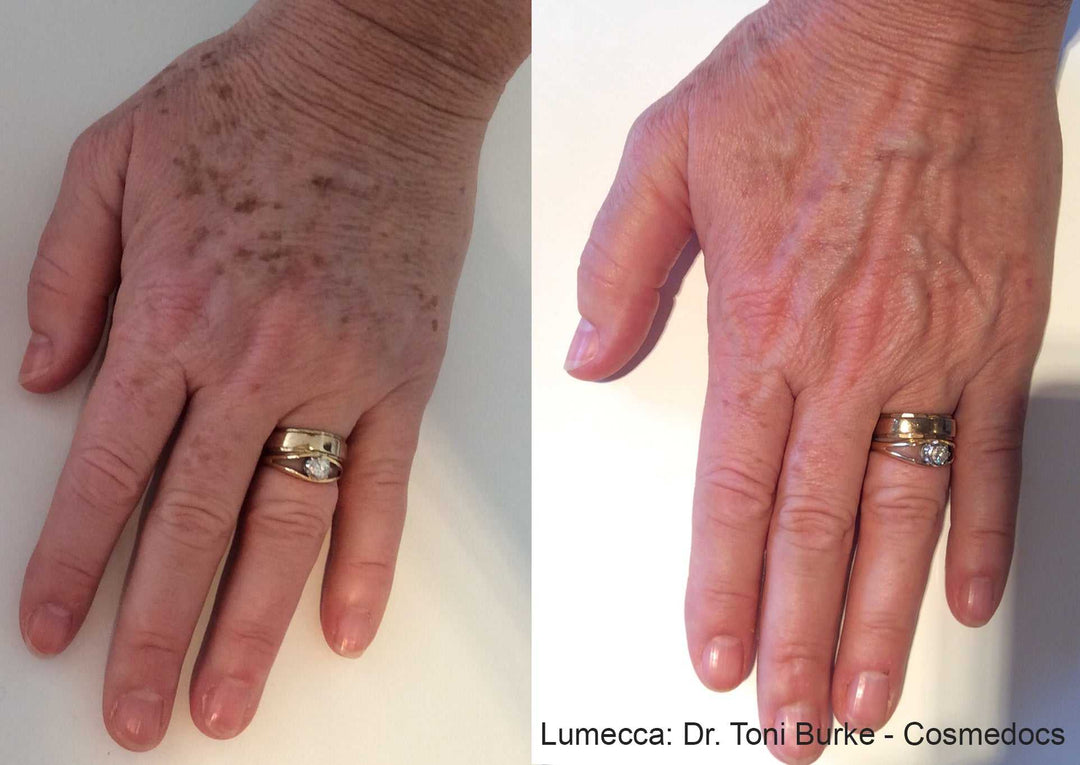 Lumecca IPL