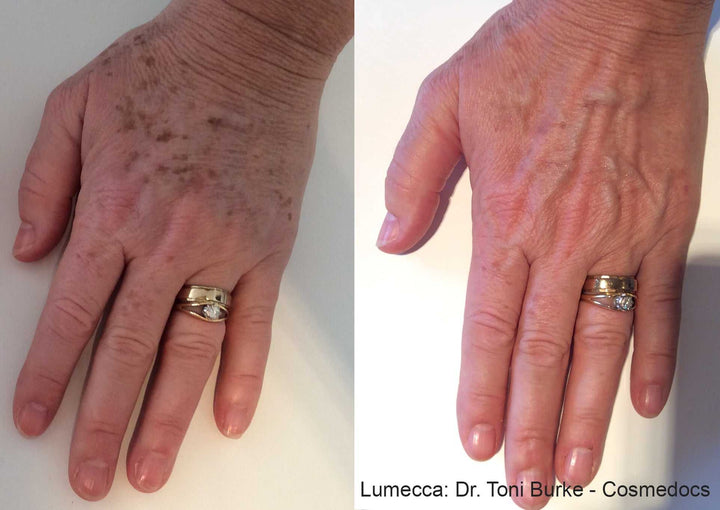 Lumecca IPL