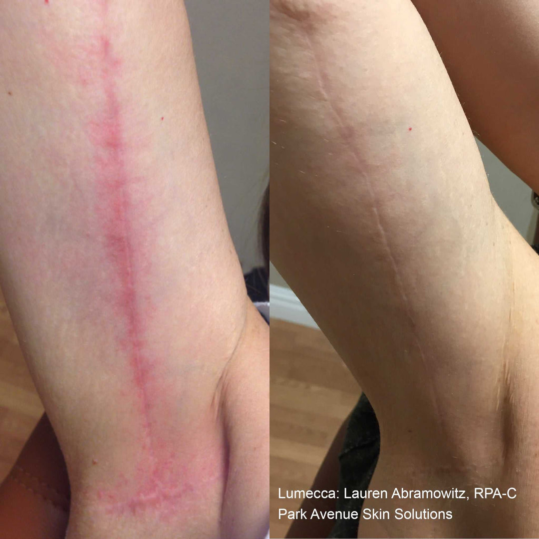 Lumecca IPL