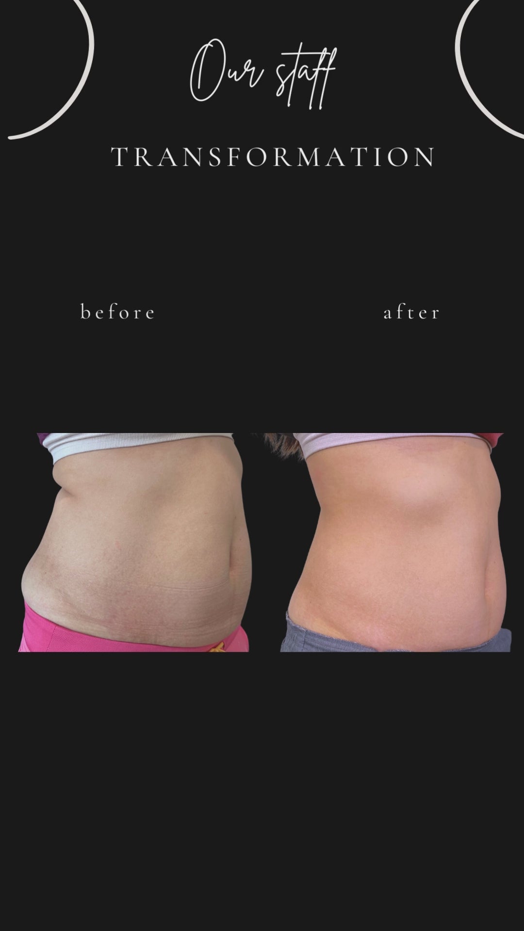 Evolve X - TRANSFORM Body Contouring