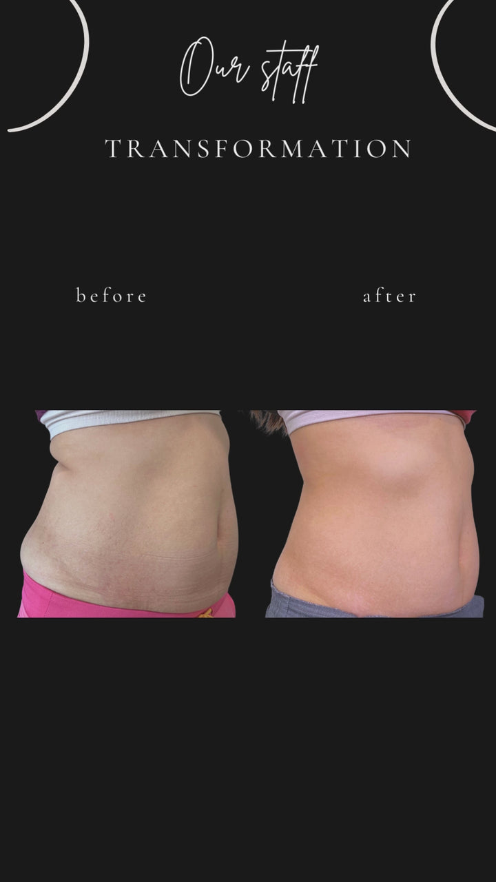 Evolve X - TRANSFORM Body Contouring